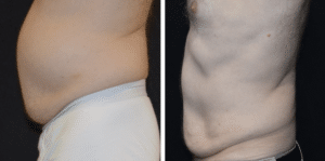 Non-Invasive Body Sculpting Treatments before and after photo